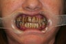 68 year old Female treated with All-on-4 Dental Implant Procedure
