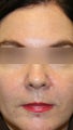 Botox and Restylane