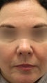 Botox and Restylane