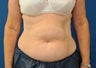 CoolSculpting