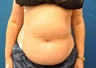CoolSculpting