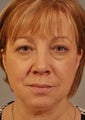 Lower lid Hetter Peel along with upper and lower eyelid surgery.