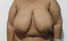 Breast reduction and lift