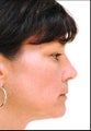 Revision rhinoplasty