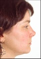 Revision rhinoplasty