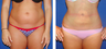 Liposuction Before & After