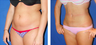 Liposuction Before & After