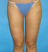 Thigh liposuction in a thin patient