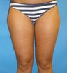 Thigh liposuction in a thin patient
