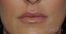 32 y/o female desired fuller lips with filler.