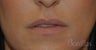 32 y/o female desired fuller lips with filler.