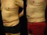 65 y/o Male SmartLipoTriplex of Abdomen, Waist and Flanks