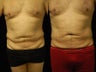 65 y/o Male SmartLipoTriplex of Abdomen, Waist and Flanks