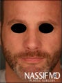 Male Revision Rhinoplasty