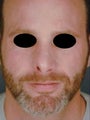 Male Revision Rhinoplasty