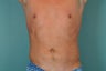 Smart Lipo