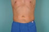Smart Lipo