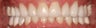 Full Mouth Rehabilitation