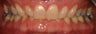 Full Mouth Rehabilitation