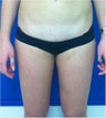 Laser Liposuction