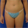 Laser Liposuction