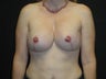 Breast reconstruction - Implants
