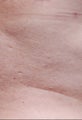 Female treated for Side Abdominal Fat