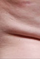 Female treated for Side Abdominal Fat