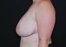 Breast Reduction