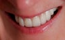 Porcelain Restorations: Bridge, Crowns, and Veneers