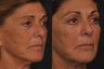 Revision lower lid blepharoplasty