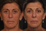 Revision lower lid blepharoplasty
