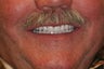 68 year old male treated with All-on-4 Dental Implant Procedure