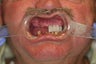68 year old male treated with All-on-4 Dental Implant Procedure