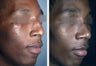 Male Patient, Rhinoplasty