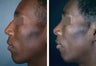 Male Patient, Rhinoplasty
