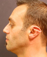 Otoplasty