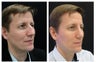 Rhinoplasty