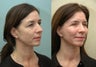 Facial Reconstructive Surgery
