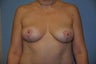 Breast Lift With Asymmetry