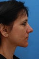 Middle Age Lady Concerned with Neck laxity