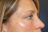 Juvederm dermal filler for upper cheek and under eyes
