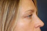 Juvederm dermal filler for upper cheek and under eyes