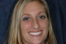 Congenitally Missing Teeth