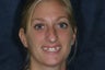 Congenitally Missing Teeth
