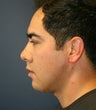 Chin & Cheek Implants and Neck-Plasty
