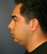 Chin & Cheek Implants and Neck-Plasty