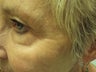 Botox Cosmetic for Upper Face