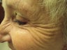 Botox Cosmetic for Upper Face