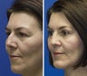 Combined Chin Implant, Rhinoplasty and Upper Lid Blepharoplasty